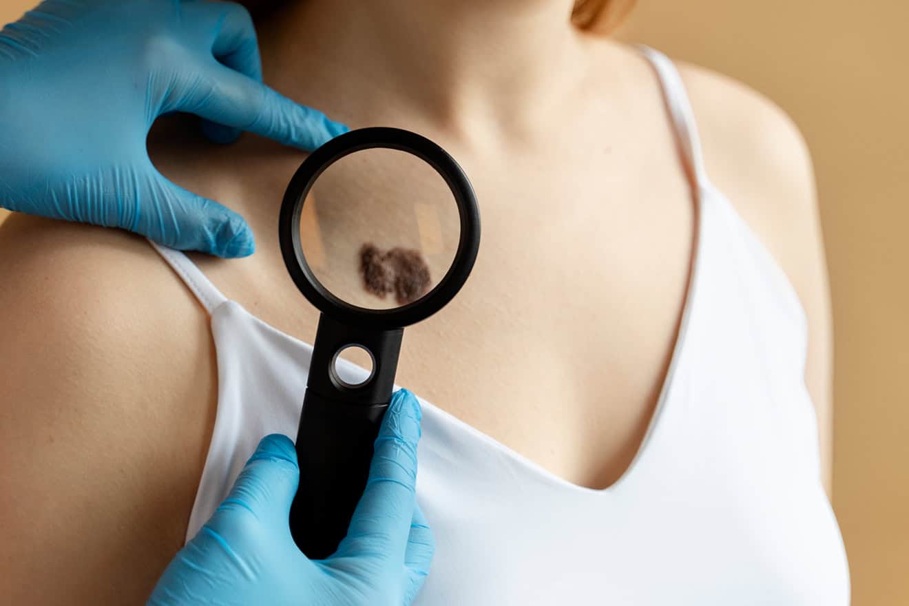 Удаление доброкачественных новообразований кожи аппаратом «Сургитрон»