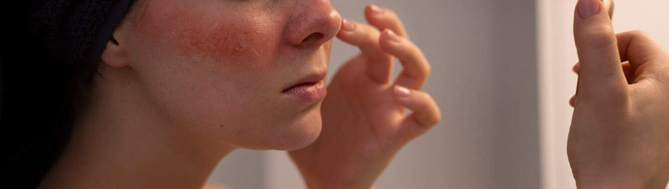 Фотодерматозы (солнечная аллергия)