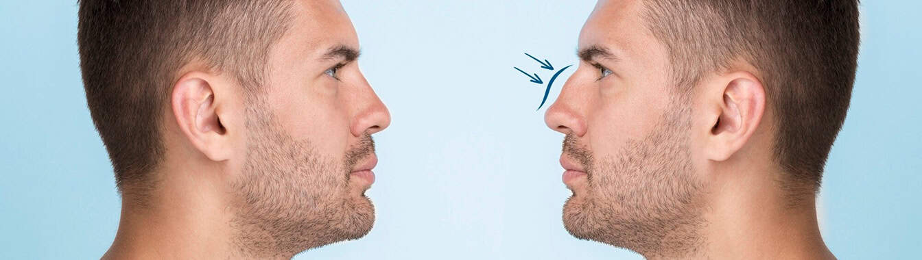 Искривление перегородки носа