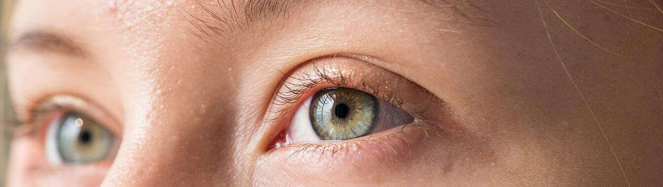 Миопия (близорукость)