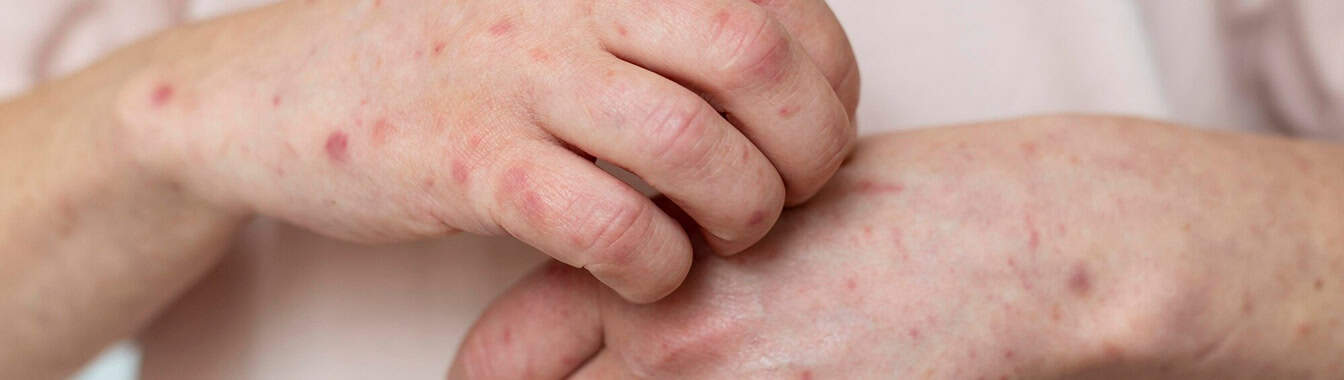 Ветряная оспа